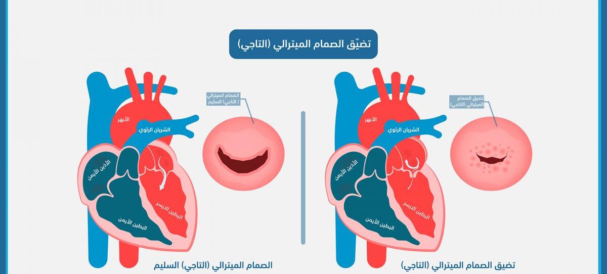 تضيق الصمام المترالي