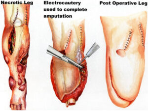 Amputation