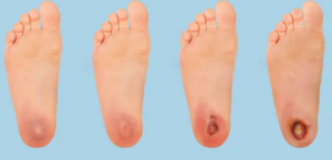 foot gangrene grades