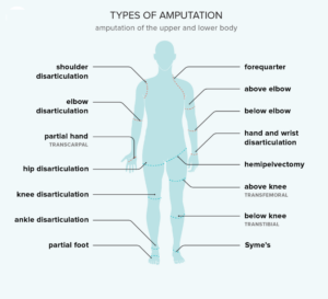 Types of amputation