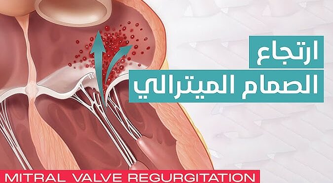 ارتجاع الصمام المترالي