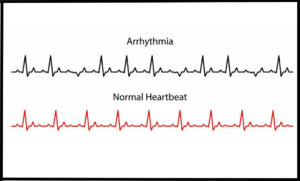 Arrhythmia on ECG