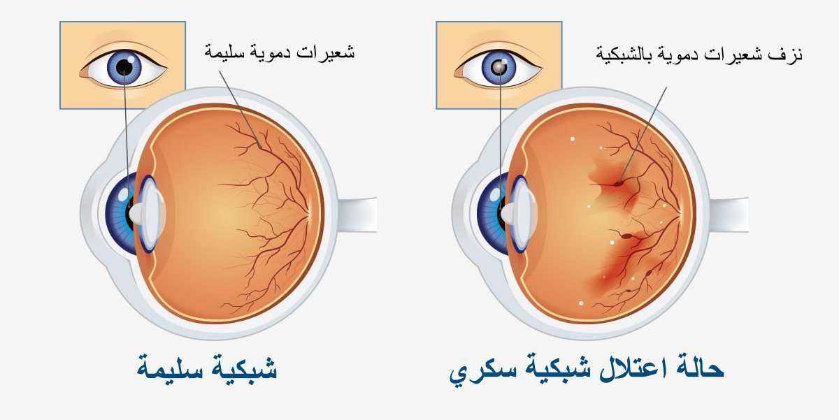 اعتلال الشبكية السكري