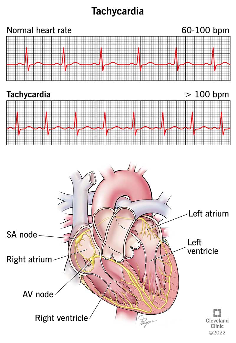 تسرّع القلب tachycardia 