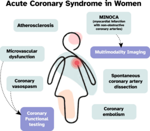الإناث الذين يعانون من متلازمة الشريان التاجي الحادة