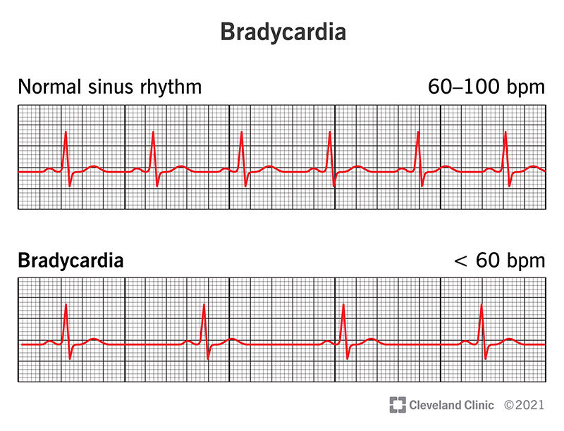 بطء القلب Bradycardia 