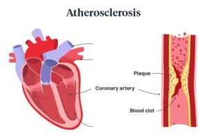 Coronary atherosclerosis