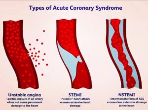 أنواع متلازمة الشريان التاجي الحادة