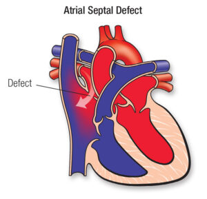 ASD