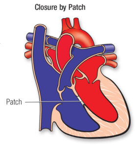 Ventricular septal defect patch closure