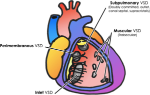 Ventricular septal defect types