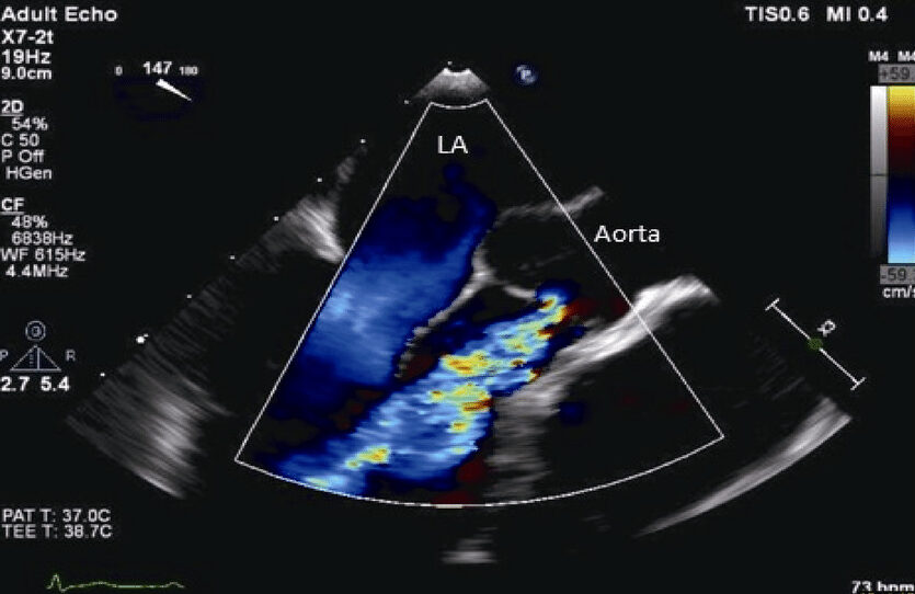مخطط صدي القلب يوضح ارتجاع في الصمام الأبهري