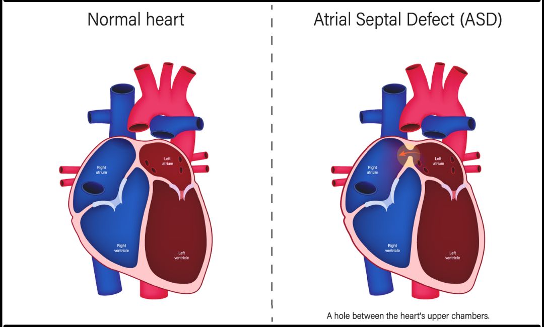 عيب الحاجز الأذيني - (ASD) Atrial septal defect - ايجي كلينك