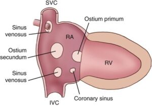 Atrial Septal Defects