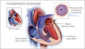 Eisenmenger Syndrome