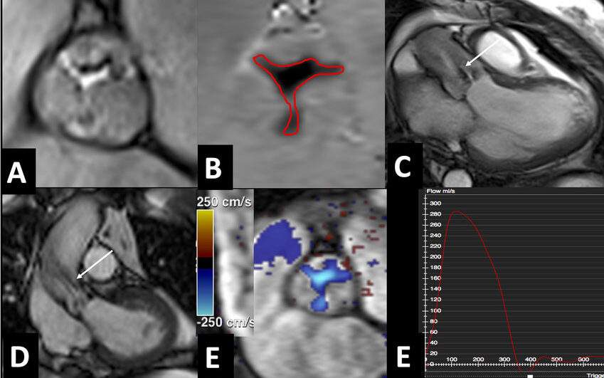 رنين مغناطيسي يوضح تضيق الصمام الأبهري