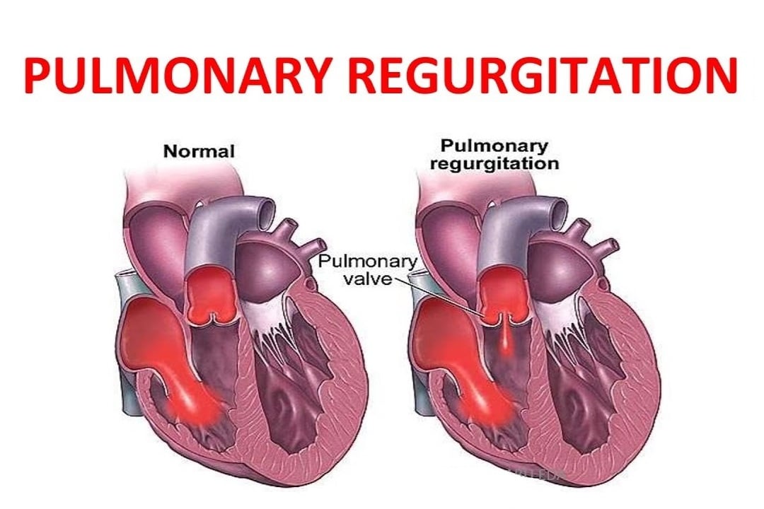 ارتجاع الصمام الرئوي