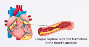 Acute Coronary Syndrome