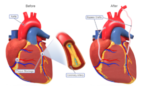 Coronary artery bypass grafting