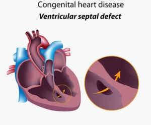 Ventricular Septal Defect