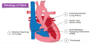 Tetralogy of Fallot