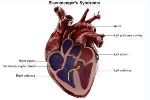 Eisenmenger Syndrome