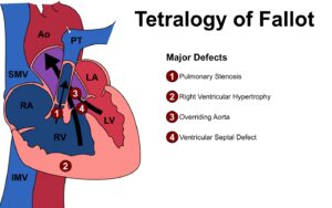 Tetralogy of Fallot