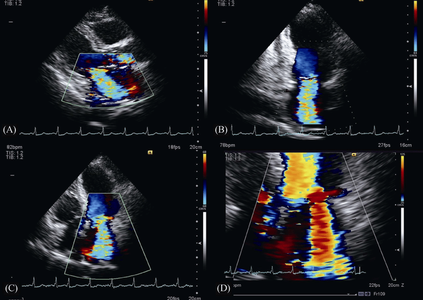 مخطط صدي القلب يوضح حدوث ارتجاع في الصمام المترالي