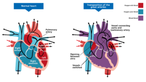 Transposition of the Great Arteries