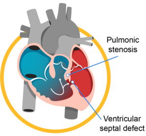 Congenital Heart Disease