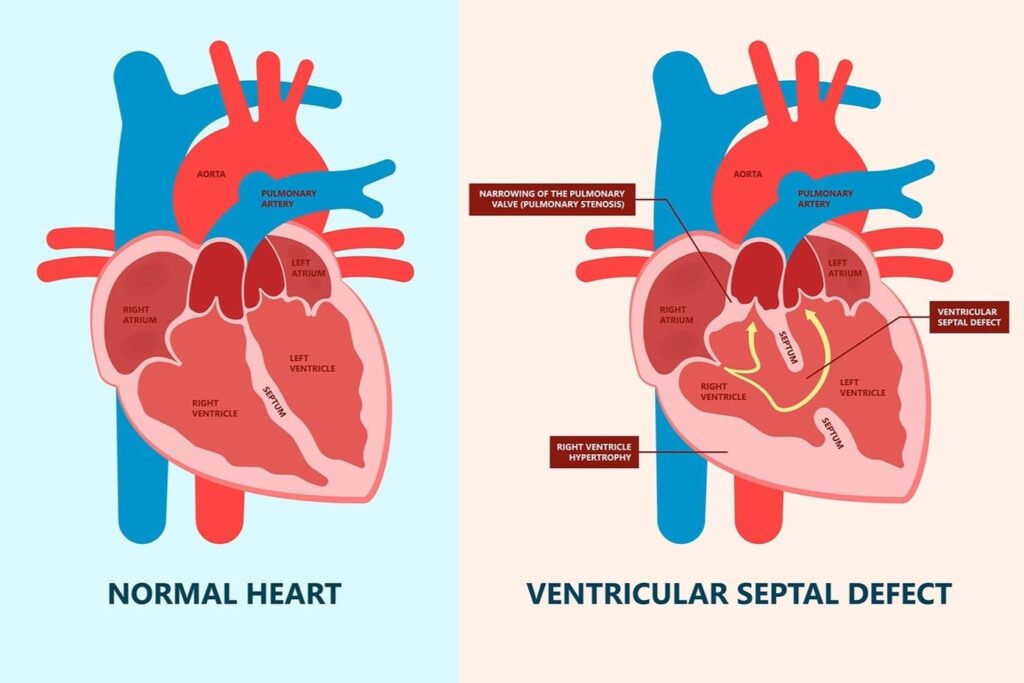 Ventricular septal defect