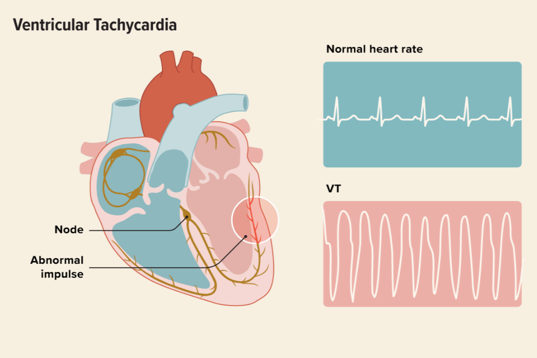 تسرع القلب البطيني - Ventricular tachycardia