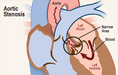 تضيق الصمام الأبهري