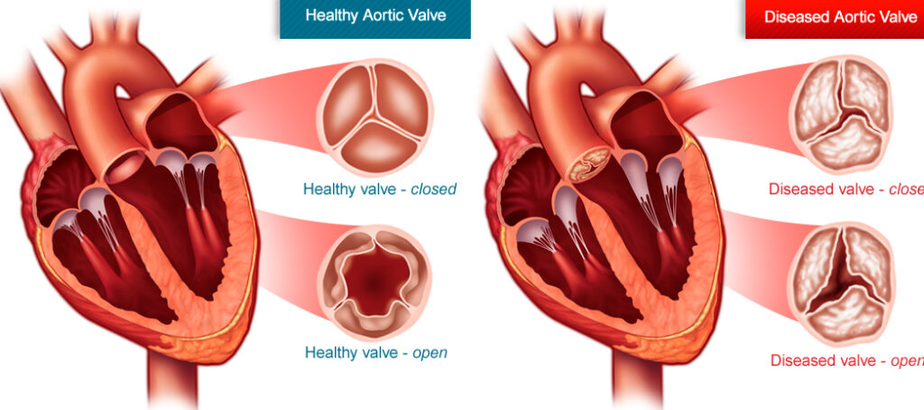 تضيق الصمام الأبهري aortic valve stenosis