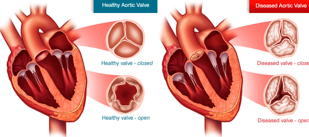 تضيق الصمام الأبهري aortic valve stenosis