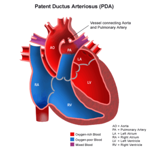 Patent ductus arteriosus