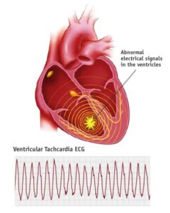 Ventricular tachycardia ECG