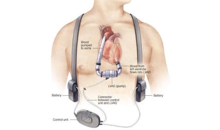 Ventricular assist device 