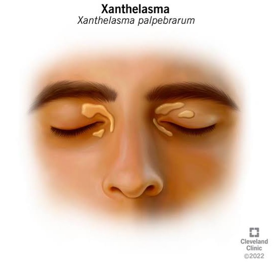 Xanthelasmas 