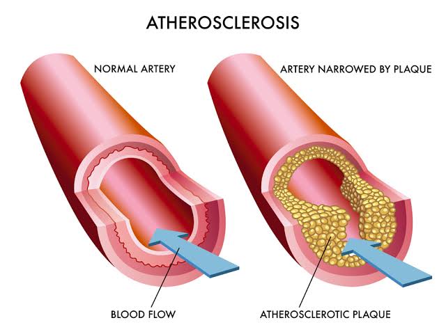 Atherosclerotic Plaque 