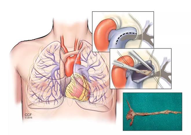 استئصال بطانة الشريان الرئوي 