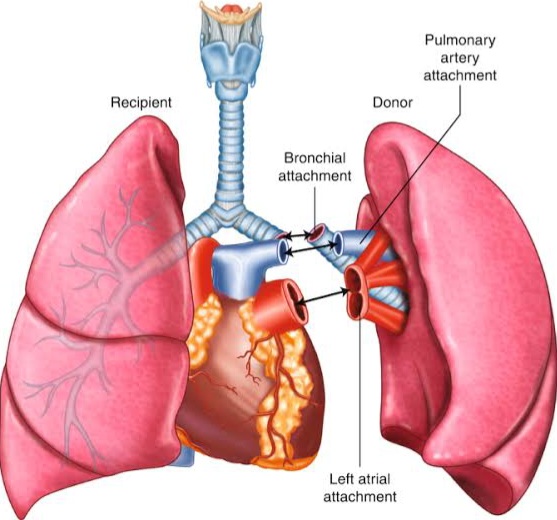 Lung transplant 