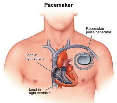 Pacemaker 