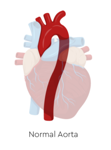 Normal Aorta