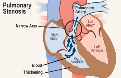 تضيق الصمام الرئوي
