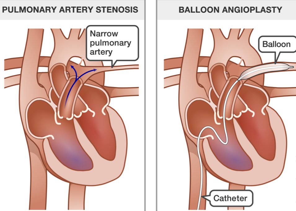 Pulmonary Artery Angioplasty 