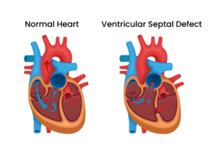 Ventricular septal defect