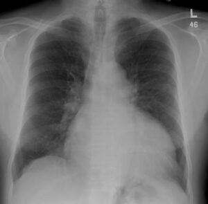 Chest X-Ray show Dilated cardiomyopathy