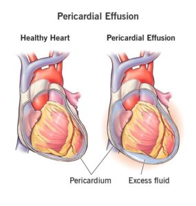 Pericardial effusion