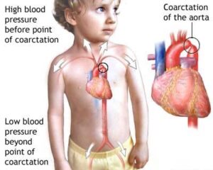 أعراض تضيق الشريان الأورطي عند الأطفال